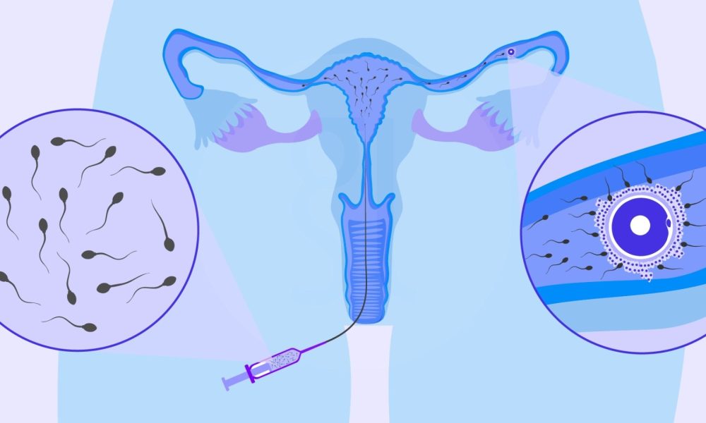 Intrauterine Insemination (IUI)