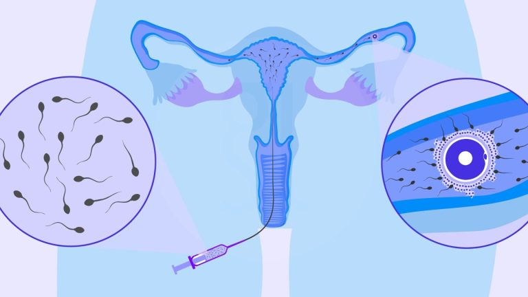 Intrauterine Insemination (IUI)